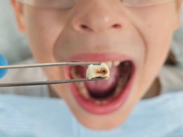Best Emergency Tooth Extraction in Fruitland, NC
